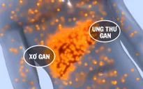 Cảnh báo tỉ lệ tử vong vì ung thư gan đứng hàng đầu Việt Nam