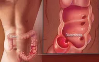 Viêm túi thừa đại tràng có nguy hiểm?