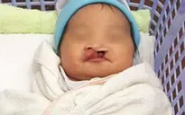 Bé gái hở hàm ếch bị bỏ rơi giữa chợ ở Kiên Giang