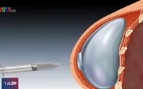 Gần 500 phụ nữ Mỹ bị ung thư do nâng ngực