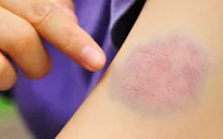 Cảnh báo ung thư qua vết bầm tím trên cơ thể