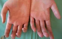 Thoát khỏi nỗi lo tăng tiết mồ hôi tay