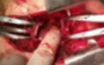 3 giờ căng thẳng cứu sống bệnh nhân tự đâm thấu tim