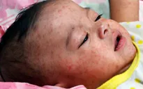 Dịch sởi tiếp tục diễn biến phức tạp tại Philippines