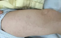 Hà Nội: Một trường hợp biến chứng viêm não - màng não do sởi