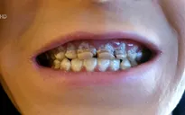 Mục nát răng vì uống nhiều nước tăng lực