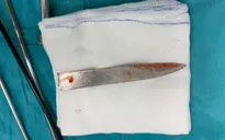 Cứu nam thanh niên bị dao đâm gãy cán nằm trong lồng ngực