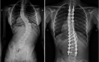 Lựa chọn phương pháp hữu hiệu điều trị bệnh cong vẹo cột sống