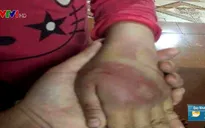 Bé gái 8 tuổi ở Thanh Hóa nghi bị bố đẻ bạo hành