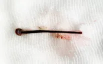 Gắp con đỉa dài 4cm sống trong mũi cô gái trẻ