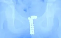 Phẫu thuật gắp 39 viên nam châm khỏi dương vật cậu bé 12 tuổi