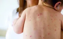 Báo động dịch sởi hoành hành trở lại tại Mỹ