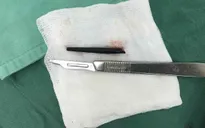 Lấy dị vật hình trụ dài 5cm trong sàn hốc mắt nam thanh niên