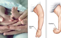 Khoảng 200 trẻ nhỏ tại Fiji cần được điều trị chân vòng kiềng mỗi năm