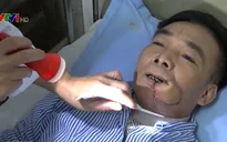 Nguy cơ ung thư khoang miệng vì hút thuốc lá