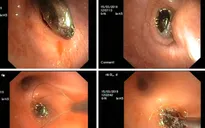 Ho suốt 1 tháng trời vì hạt hồng xiêm "trốn" trong phế quản