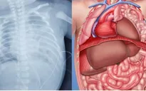 Phẫu thuật thoát vị cơ hoành bẩm sinh cho trẻ 2 ngày tuổi