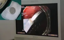 Thêm một trường hợp trẻ bị hóc đồng xu do đùa nghịch