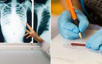 Bệnh lao có thể được "thanh toán" vào năm 2045