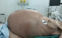 Cắt u nang buồng trứng nặng 30kg ở... cụ bà 78 tuổi