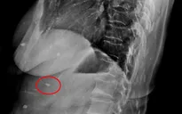 Rùng mình sán lá gan ký sinh khắp cơ thể một phụ nữ