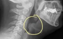 Đột ngột đau họng, khó nuốt - nói, khó thở: Coi chừng viêm thanh thiệt
