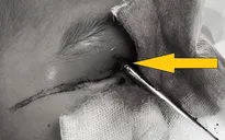 Vấp ngã, bé trai 5 tuổi bị thanh sắt đâm xuyên mắt lên não