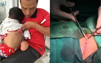 Cắt bỏ khối u đeo bám 4 năm cho bé gái người dân tộc Mông