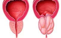 Biểu hiện phì đại tuyến tiền liệt nam giới cần biết