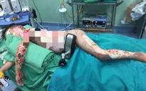 Thương tâm bé trai 8 tuổi người dân tộc H'Mông bị bỏng xăng