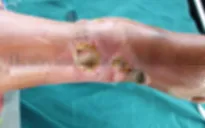 Tìm thầy lang trị ngứa, người phụ nữ nhập viện vì chân hoại tử