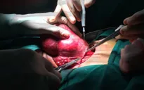 Khối u giáp khổng lồ chèn ép khí quản người phụ nữ