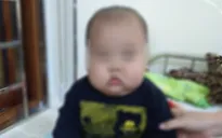 Bé trai bị phù mặt, suy thận do uống thuốc không theo đơn