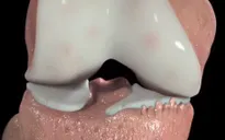 Bệnh thoái hóa khớp gối: Dấu hiệu và cách điều trị