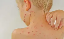 Bỏ túi cách ngừa bệnh dị ứng gây phiền toái mùa đông