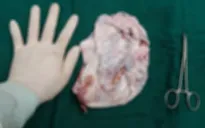 Tưởng con gái 10 tuổi béo lên, đi khám phát hiện u nang buồng trứng