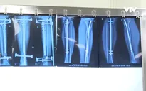 Thành công mới trong triển khai phẫu thuật kéo dài chân