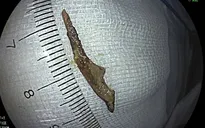Mảnh xương dài 3cm "lẩn trốn" trong ruột thừa người đàn ông