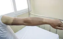 Nổ bóng bay: 4 người đàn ông bị bỏng khí hidro