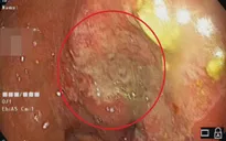 Đau thượng vị uống thuốc không khỏi, đi khám phát hiện ung thư dạ dày