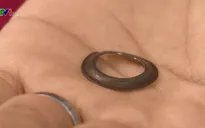 Mổ lấy dị vật trong họng bé trai