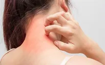 Biến đổi khí hậu có thể làm cho bệnh dị ứng theo mùa tồi tệ hơn