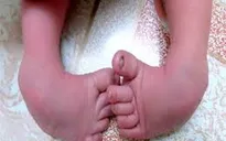 Khám sàng lọc cho trẻ mắc tật cơ xương khớp và sẹo bỏng tại Cần Thơ