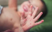 Số ca nhiễm sởi gia tăng tại Thụy Sĩ