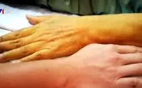 Ấn Độ: Tử vong do nghi dùng thực phẩm chức năng để giảm cân