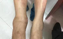 Bó lá nhà thầy lang trị gãy xương: Ngậm ngùi chịu di chứng