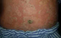 Tự điều trị vảy nến bằng thuốc đông y, người đàn ông bị ung thư da