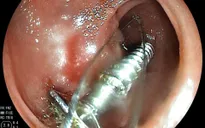 Nuốt đinh vít, bé 20 tháng phải nhập viện cấp cứu