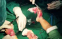 Máy cắt cỏ cắt nát 2 bàn chân bé 2 tuổi