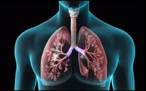 Trẻ sinh non dễ bị mắc bệnh phổi tắc nghẽn mạn tính